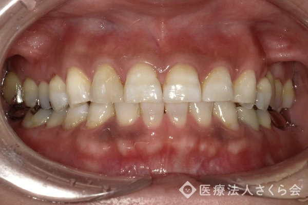 ホワイトニング治療後